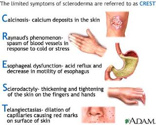 Systemic Sclerosis (scleroderma) - MDNotes