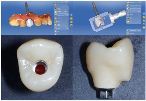 Custom abutment 2 - Digital Enamel