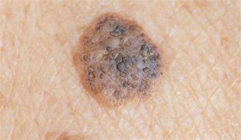 Seborrheic Keratosis vs. Melanoma | Vujevich Dermatology Associates