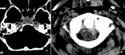 A. CT scan (bone window) transverse clival fracture. B. CT scan ...