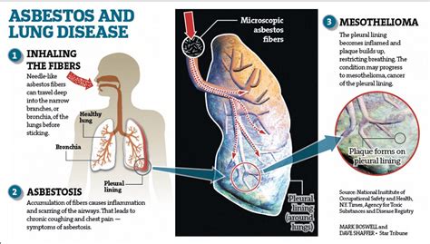 Asbestos Lung Disease - Mesothelioma