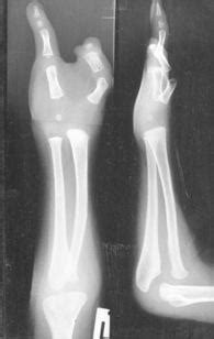 Ulnar Club Hand - Hand - Orthobullets