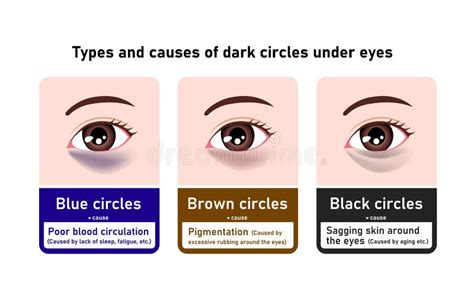 Types and Causes of Dark Circles Under Eyes. Vector Illustration Stock ...