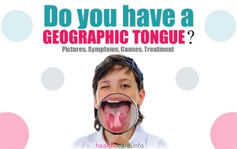 geographic tongue symptoms - pictures, photos