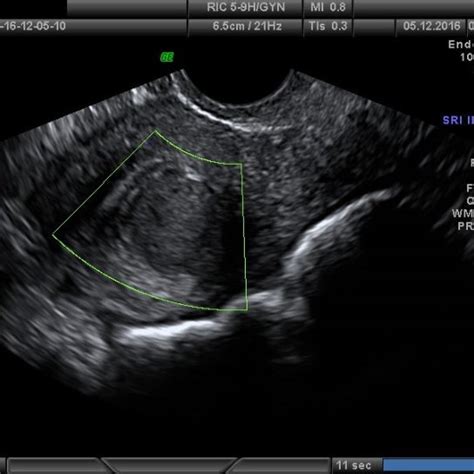 (PDF) Concepts and Thoughts about Modern Uterine Intramural and ...