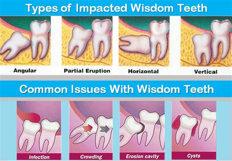 Tips to Speed up Recovery After Wisdom Teeth Removal | After wisdom ...