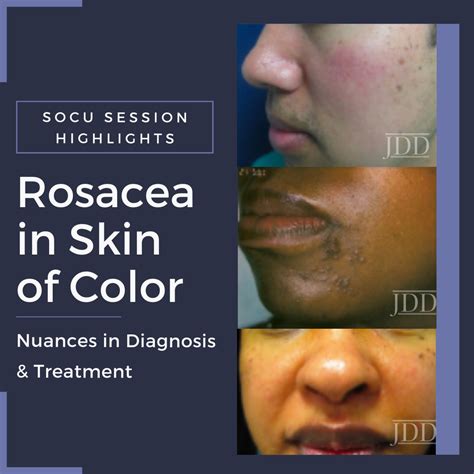 Rosacea in Skin of Color Patients: Nuances in Diagnosis & Treatment ...