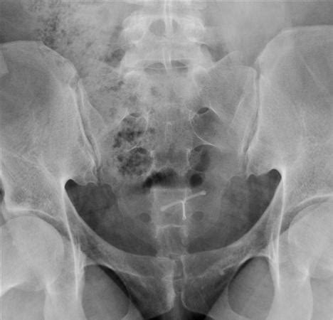 Sacral Fractures - Trauma - Orthobullets