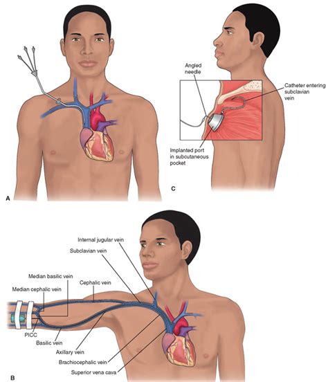 Administration of Injectable Medications (Pharmacology and ...