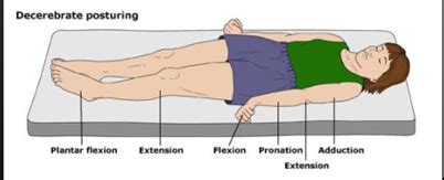 Glasgow Coma Scale Abnormal Flexion