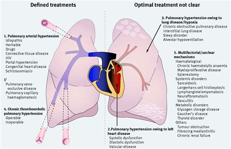 Pulmonary hypertension: diagnosis and management | The BMJ