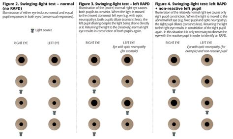 Community Eye Health Journal » How to test for a relative afferent ...