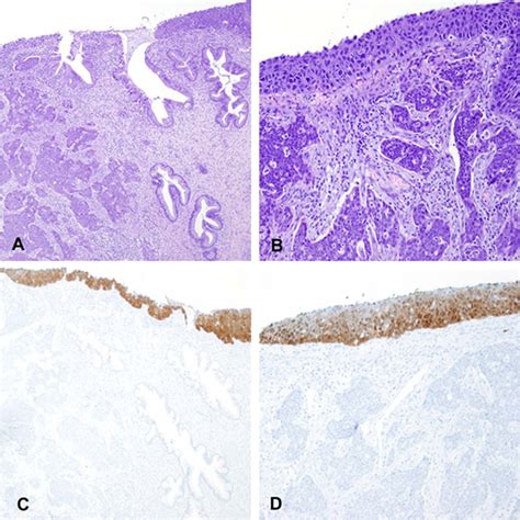 Prognostic implications of genotyping and p16 immunostaining in HPV ...