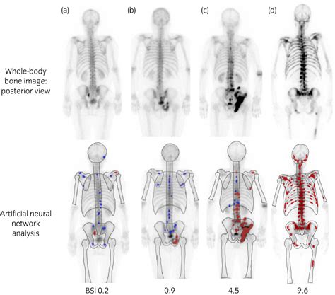 Normal Bone Scan