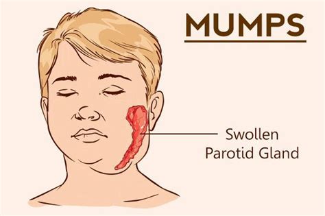 Treatment for Mumps - MEDizzy