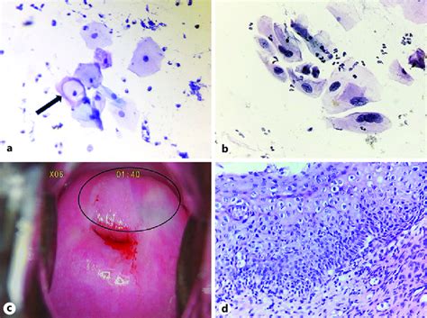 Panel showing cervical smear with koilocytic change (arrow in a) and ...