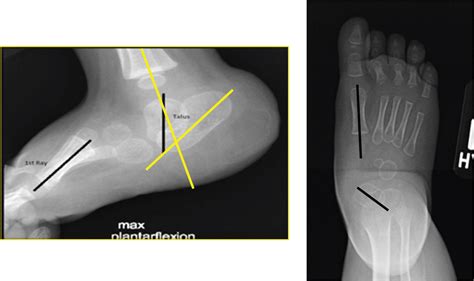 An Algorithmic Approach to the Congenital Vertical Talus - Journal of ...