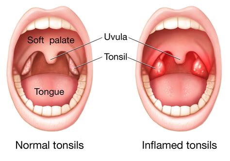 Swollen Tonsils: Tonsillitis, Symptoms, Causes, And More, 51% OFF