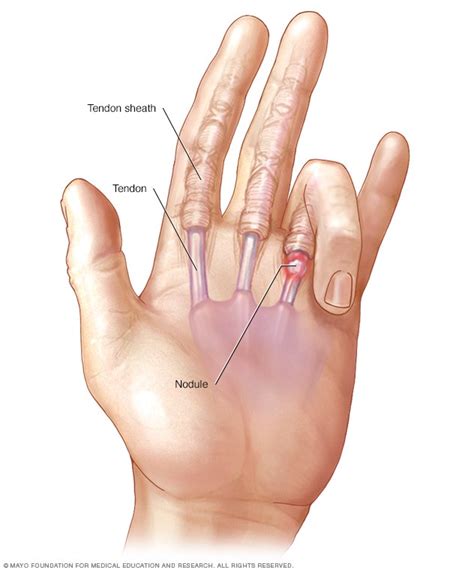 Dedo en gatillo - Síntomas y causas - Mayo Clinic