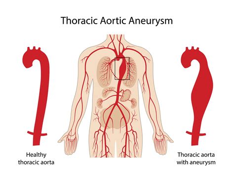 Thoracic Aneurysm & Dissection | UWMTAP