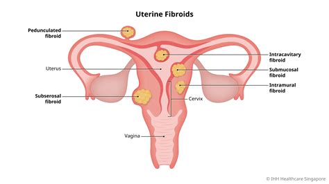 Uterine Fibroid (Myoma) - Causes and Symptoms | Parkway East Hospital