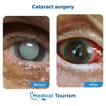 Best Doctors For Cataract Surgery | Medical Tourism Mexico