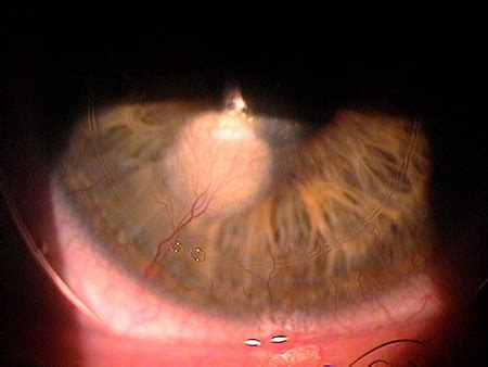 Corneal Neovascularization