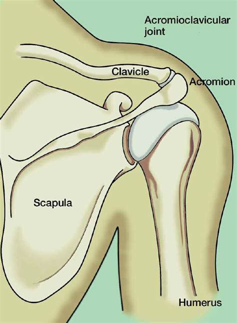 Acromioclavicular (AC) Joint Separation Repair - The Institute for ...