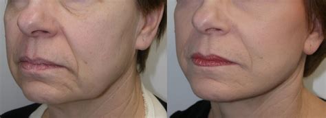 Sagging Jowls | Jaw Line | Castleknock Cosmetic Clinic Dublin ...