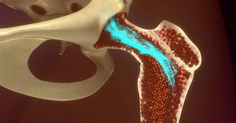 Bone Marrow Cancer Stages - CancerOz