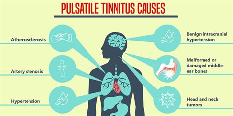 Pulsatile Tinnitus: Causes, Treatment Options