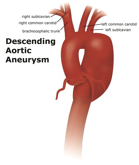 Aorta Artery Aneurysm