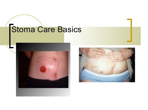 Stoma Care Plan Template