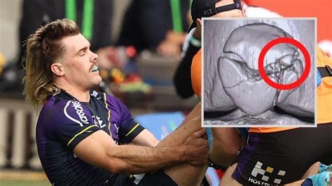 NRL news 2022: Ryan Papenhuyzen fracture knee cap, gruesome detail in X ...