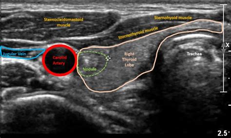 Thyroid Ultrasound: Purpose and Procedure | Healthtian