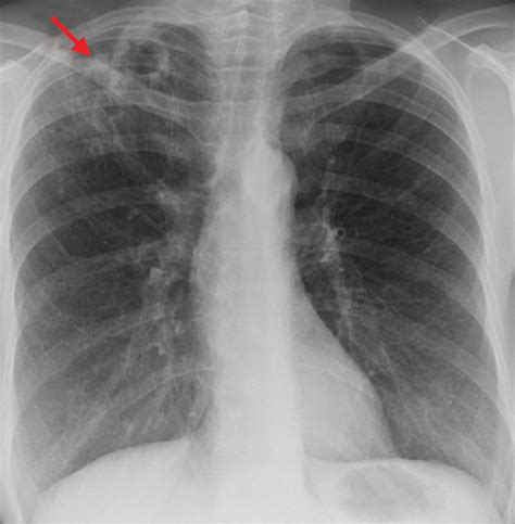 A Case of Lung Cancer Originating from Cavitary Mycobacterium xenopi ...