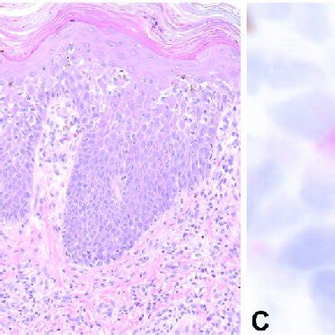 Patient 1. A, Clinical image of lichenoid dermatitis on the left thigh ...