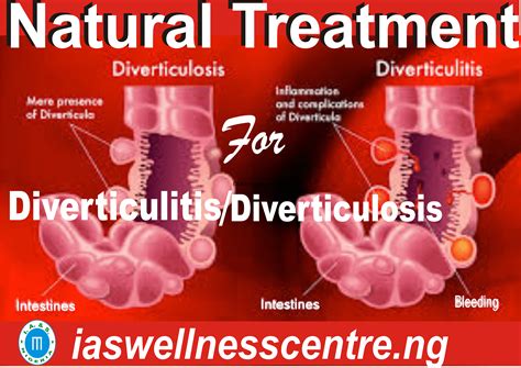 DIVERTICULITIS/DIVERTICULOSIS AND IT'S NATURAL TREATMENT IN NIGERIA - I ...