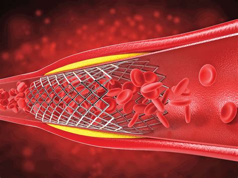 Complications après avoir reçu un stent - ThePressFree