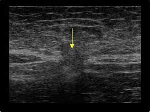 Ventral Hernia Ultrasound