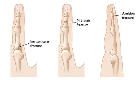 Finger Fractures - OrthoInfo - AAOS