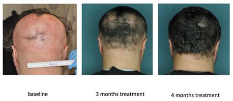 Drug Restores Hair Growth in Patients with Alopecia Areata | Columbia ...