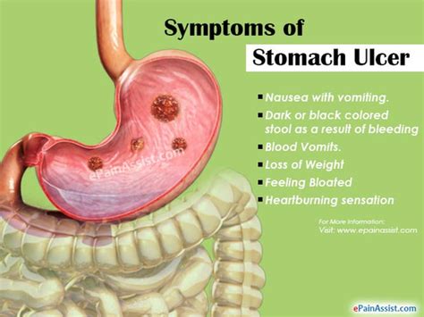 Gastric Ulcer - Healthcare Blog Article By Dr. O