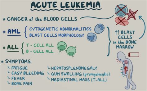 Chemotherapy for Leukemia - zeepedia.com