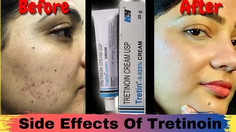 Tretinoin side effects | Tretinoin for oily, acne prone,dry ...