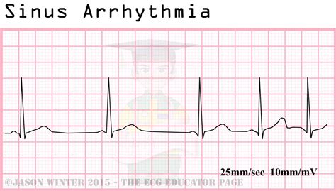 ECG Educator Blog : Sinoatrial Node rhythms