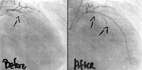 CT Coronary Angiogram: 4 Reasons Why it is Done - Pulse Cardiology