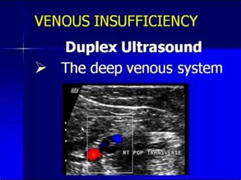 Parents Network Life: Venous Reflux Ultrasound Grading