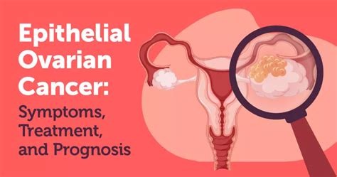 Epithelial Ovarian Cancer: Symptoms, Treatment, and Prognosis ...