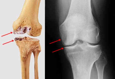 driving after partial knee replacement - doxonfaruolo